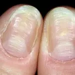 волнистые ногти